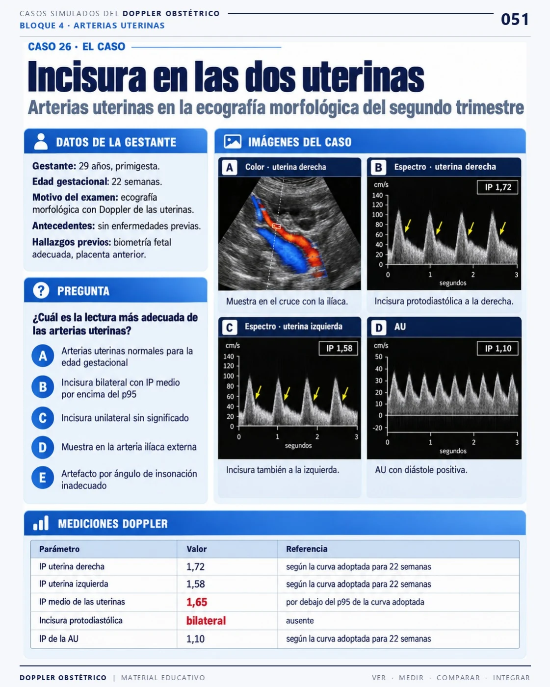 Página 51: Caso 26: incisura en ambas uterinas. Extracto del PDF de Doppler Obstétrico y Fetal.
